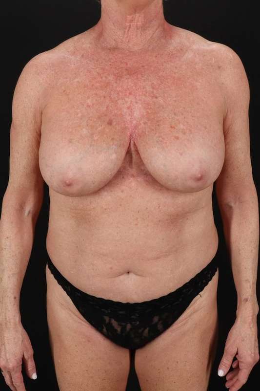 All Me Augmentation Before & After Patient #2921