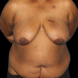 DIEP Flap Before & After Patient #2930