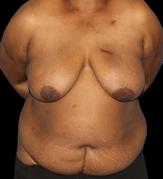 DIEP Flap Before & After Patient #2930