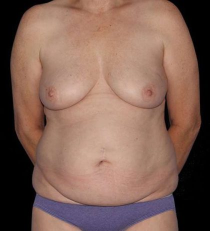 DIEP Flap Before & After Patient #2943