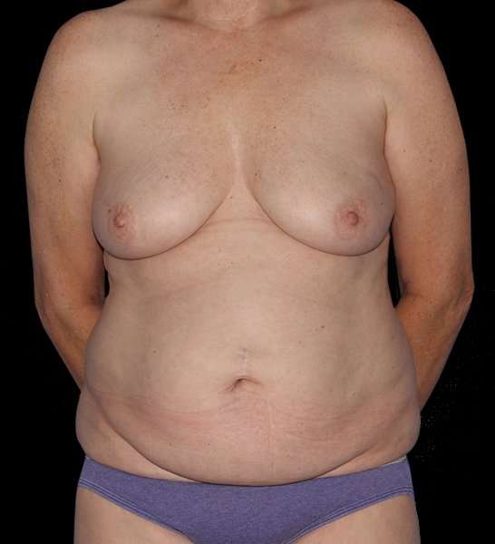 DIEP Flap Before & After Patient #2943