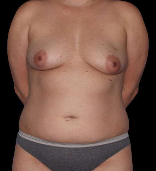 DIEP Flap Before & After Patient #2954