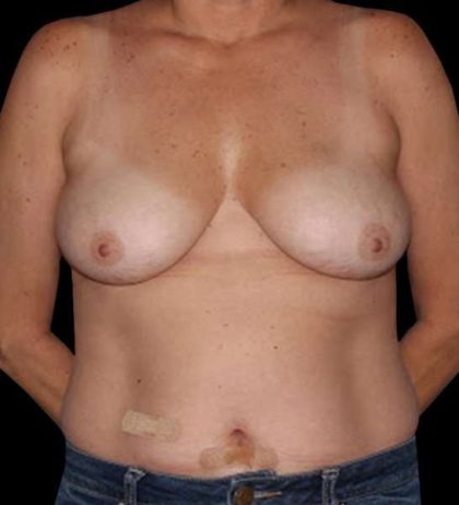 DIEP Flap Before & After Patient #2962