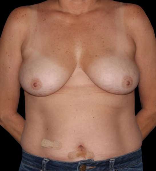 DIEP Flap Before & After Patient #2962