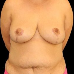 DIEP Flap Before & After Patient #2974