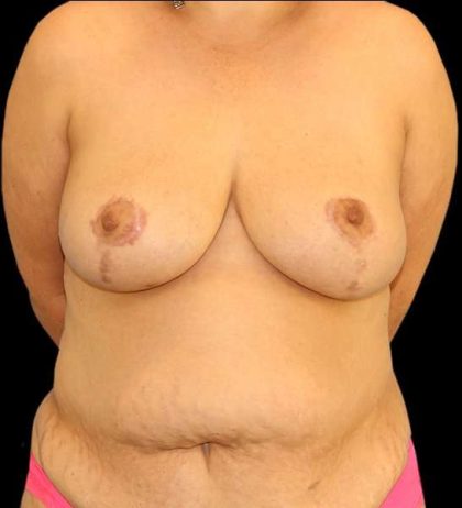 DIEP Flap Before & After Patient #2974