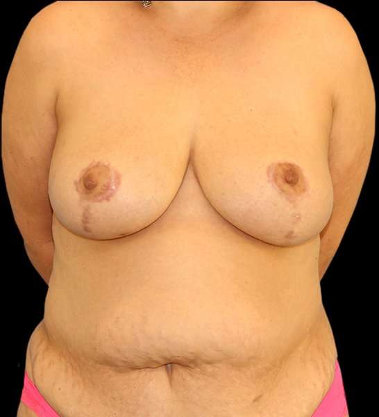 DIEP Flap Before & After Patient #2974