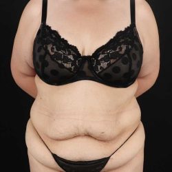 Abdominoplasty (Tummy Tuck) Before & After Patient #830