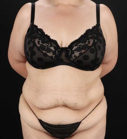 Abdominoplasty (Tummy Tuck) Before & After Patient #830