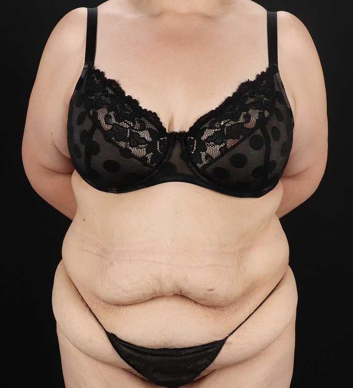 Abdominoplasty (Tummy Tuck) Before & After Patient #830