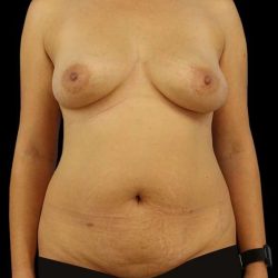 DIEP Flap Before & After Patient #3004