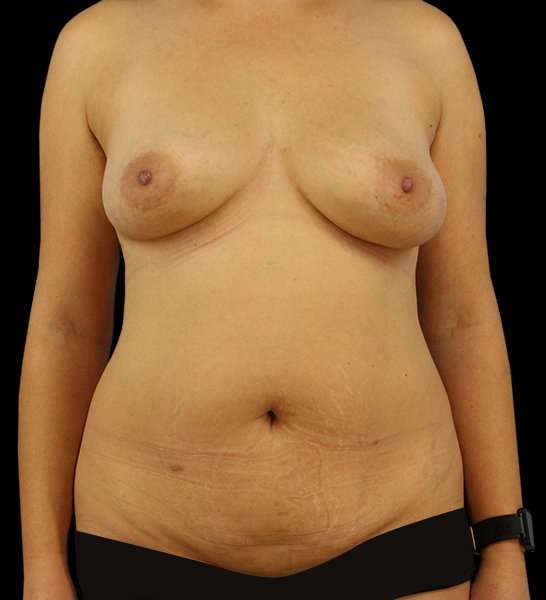DIEP Flap Before & After Patient #3004