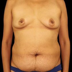 DIEP Flap Before & After Patient #3019