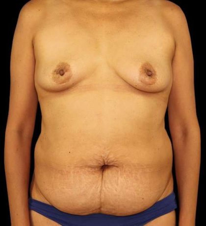 DIEP Flap Before & After Patient #3019