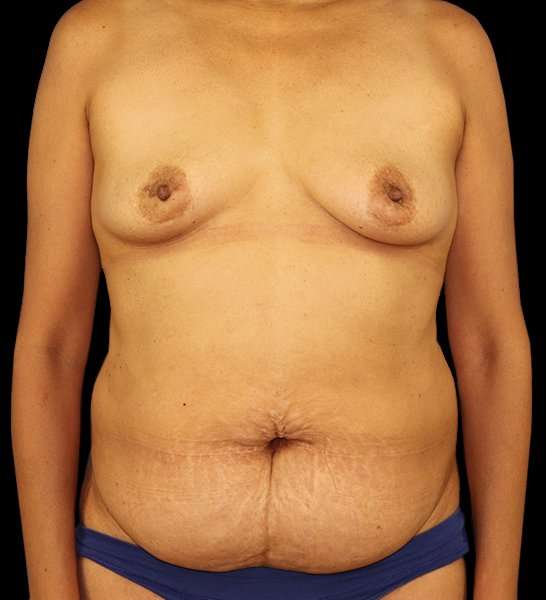 DIEP Flap Before & After Patient #3019