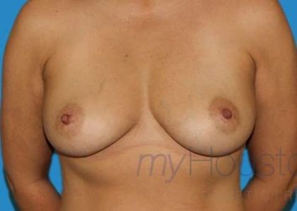 DIEP Flap Before & After Patient #3036