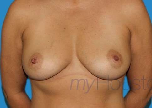 DIEP Flap Before & After Patient #3036
