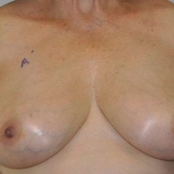 DIEP Flap Before & After Patient #3045