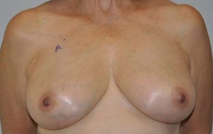 DIEP Flap Before & After Patient #3045