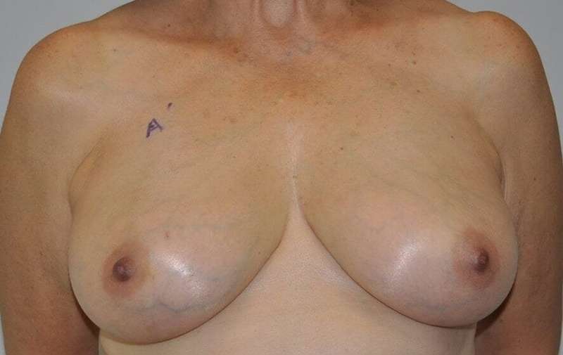 DIEP Flap Before & After Patient #3045