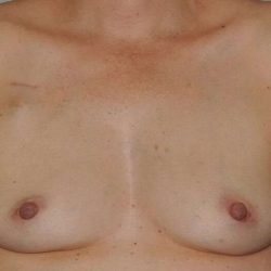 DIEP Flap Before & After Patient #3049