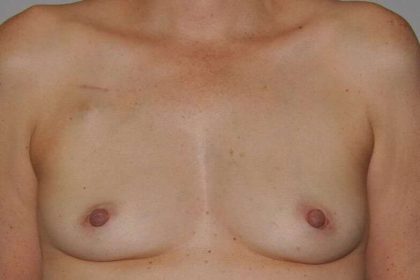DIEP Flap Before & After Patient #3049