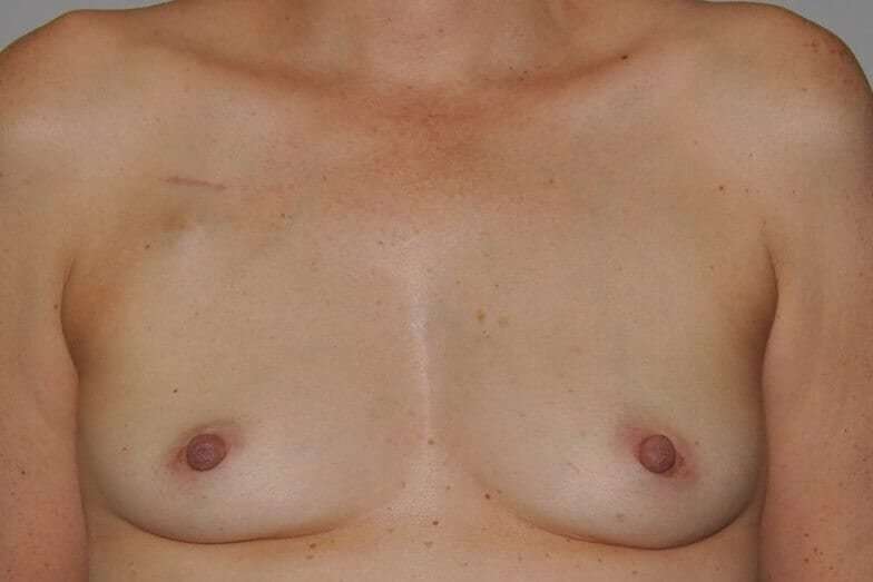 DIEP Flap Before & After Patient #3049
