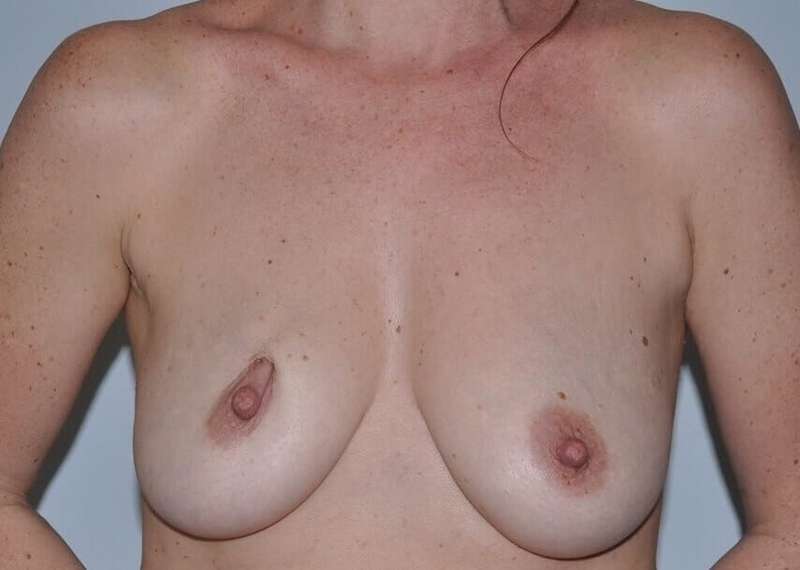 DIEP Flap Before & After Patient #3052