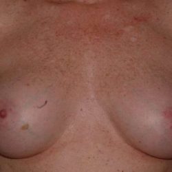 DIEP Flap Before & After Patient #3058