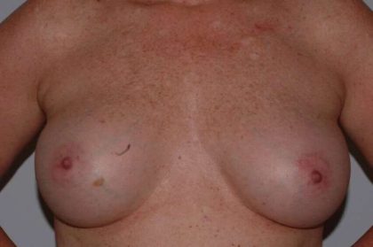 DIEP Flap Before & After Patient #3058