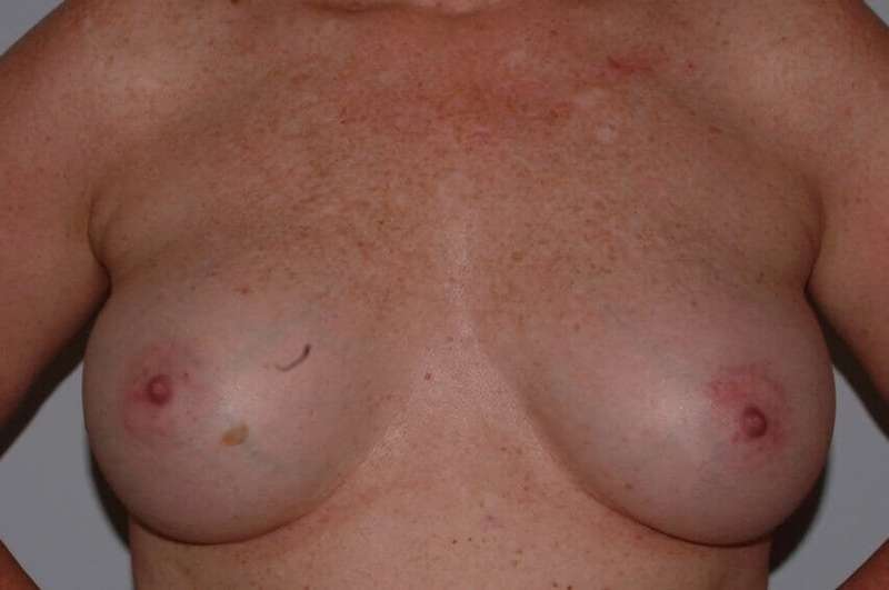 DIEP Flap Before & After Patient #3058