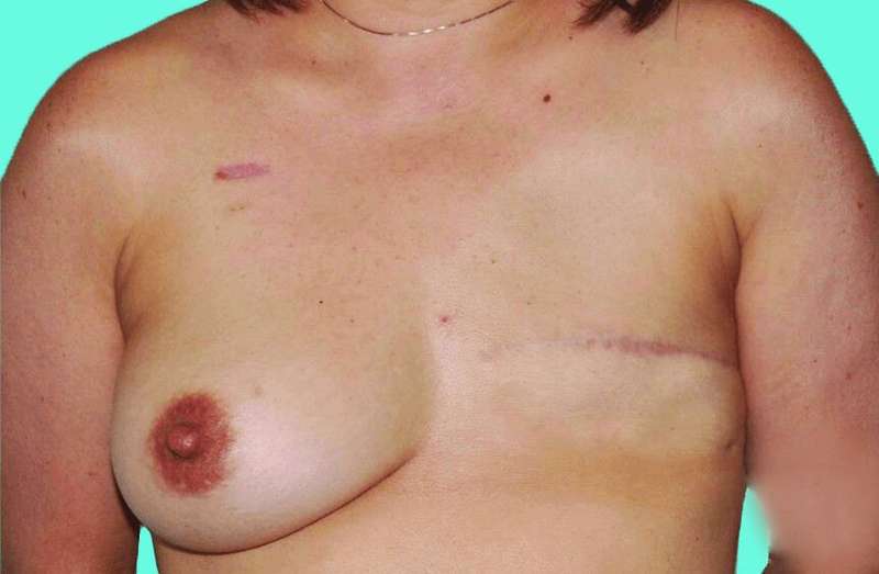 DIEP Flap Before & After Patient #3064