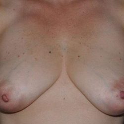DIEP Flap Before & After Patient #3067