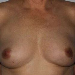 DIEP Flap Before & After Patient #3070