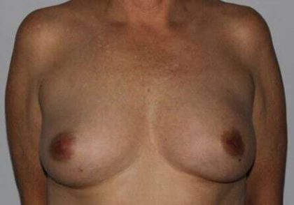 DIEP Flap Before & After Patient #3070