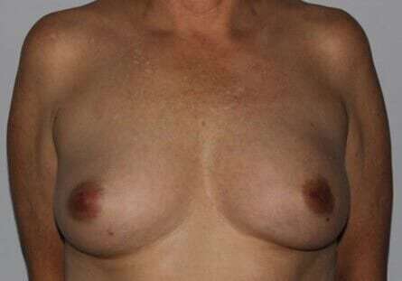 DIEP Flap Before & After Patient #3070
