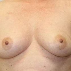 DIEP Flap Before & After Patient #3073
