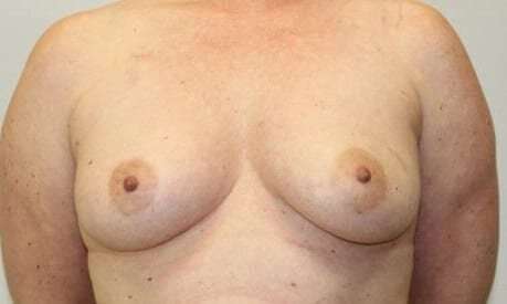 DIEP Flap Before & After Patient #3073