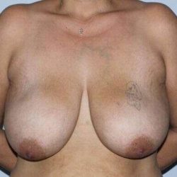 DIEP Flap Before & After Patient #3080