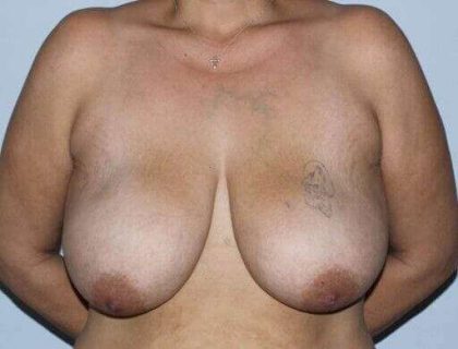 DIEP Flap Before & After Patient #3080