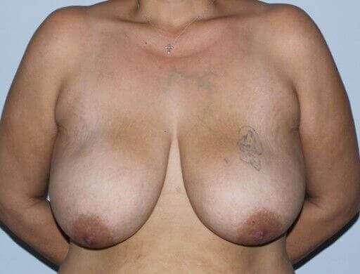 DIEP Flap Before & After Patient #3080