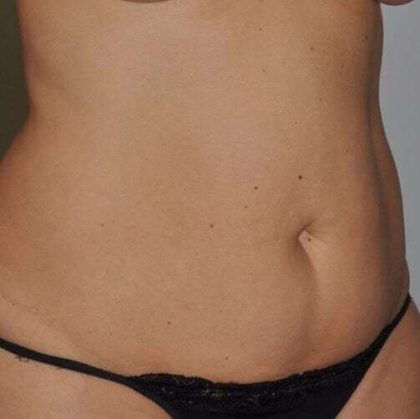 Abdominoplasty (Tummy Tuck) Before & After Patient #848