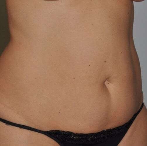 Abdominoplasty (Tummy Tuck) Before & After Patient #848