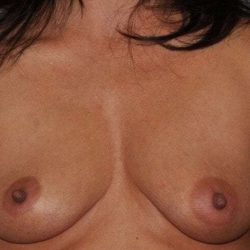 DIEP Flap Before & After Patient #3083