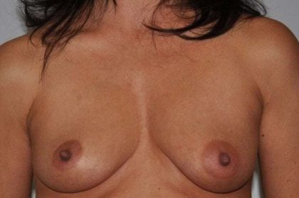 DIEP Flap Before & After Patient #3083