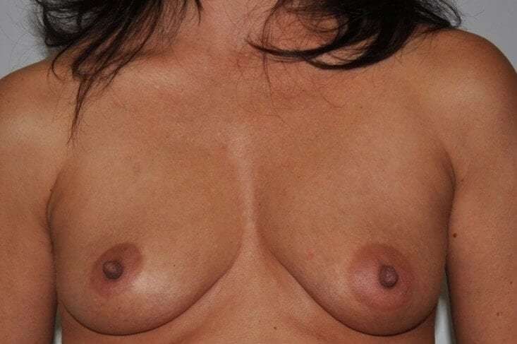 DIEP Flap Before & After Patient #3083