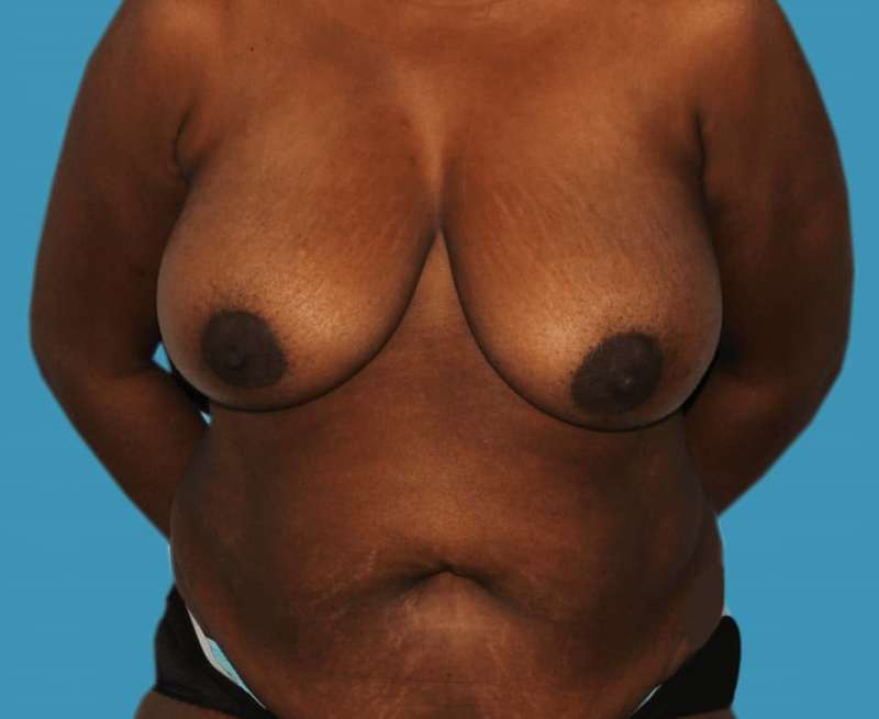 DIEP Flap Before & After Patient #3086