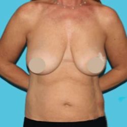 DIEP Flap Before & After Patient #3096