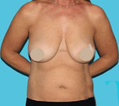 DIEP Flap Before & After Patient #3096