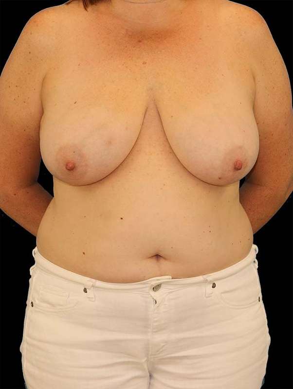 DIEP Flap Before & After Patient #3110